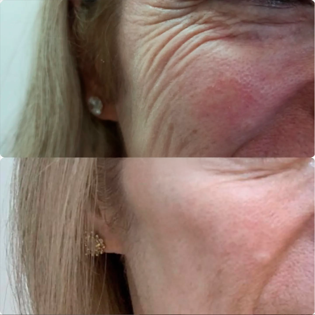 Botox 2