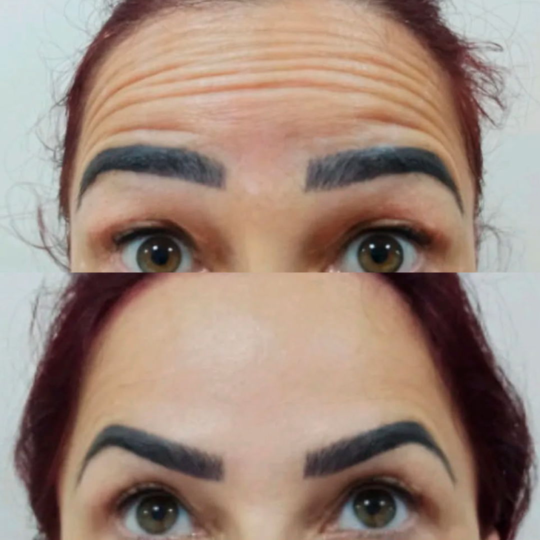 Botox